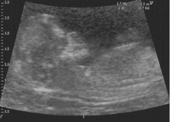 Ultrazvukový snímek šíjového projasnění