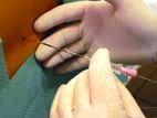 aplikace epidurální analgezie foto3
