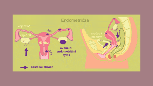 Endometrióza může být příčinou vaší neplodnosti - obrázek