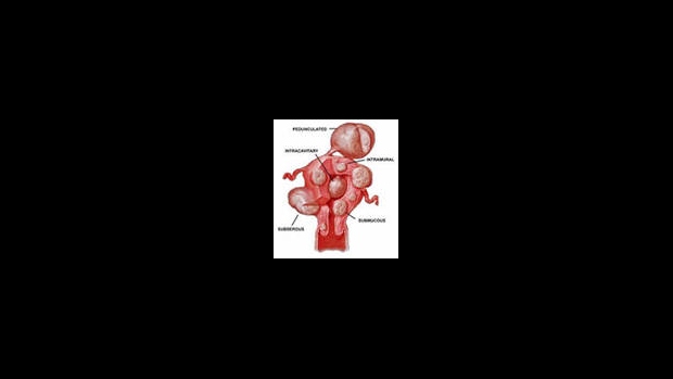 Děložní myomy - obrázek