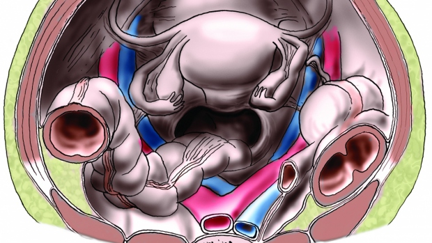 Tubární (vejcovodové) těhotenství - obrázek