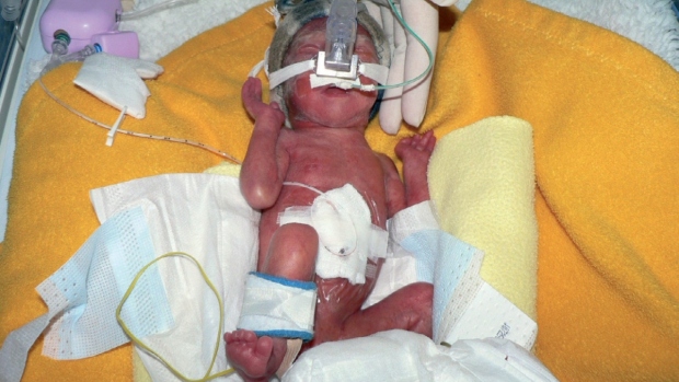 RSV infekce u předčasně narozených dětí - obrázek