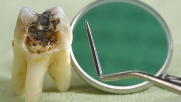 Vliv stravy na vznik a rozvoj  zubního kazu - 1.díl - obrázek