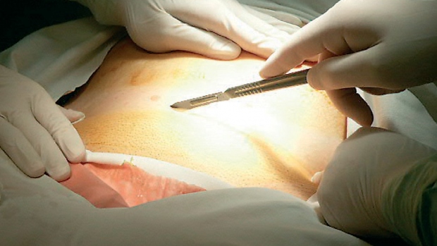 Záněty apendixu - appendicitis v těhotenství - obrázek