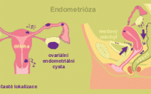 Endometrióza může být příčinou vaší neplodnosti - obrázek