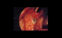 Endometrióza - obrázek