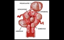 Děložní myomy - obrázek