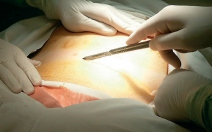 Záněty apendixu - appendicitis v těhotenství - obrázek