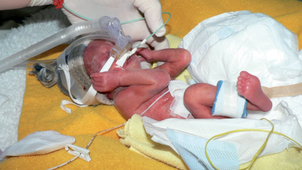 Předčasně narozené děti - obrázek